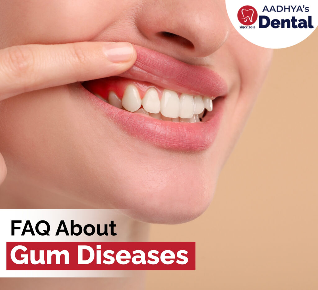 FAQ ABOUT GUM DISEASES