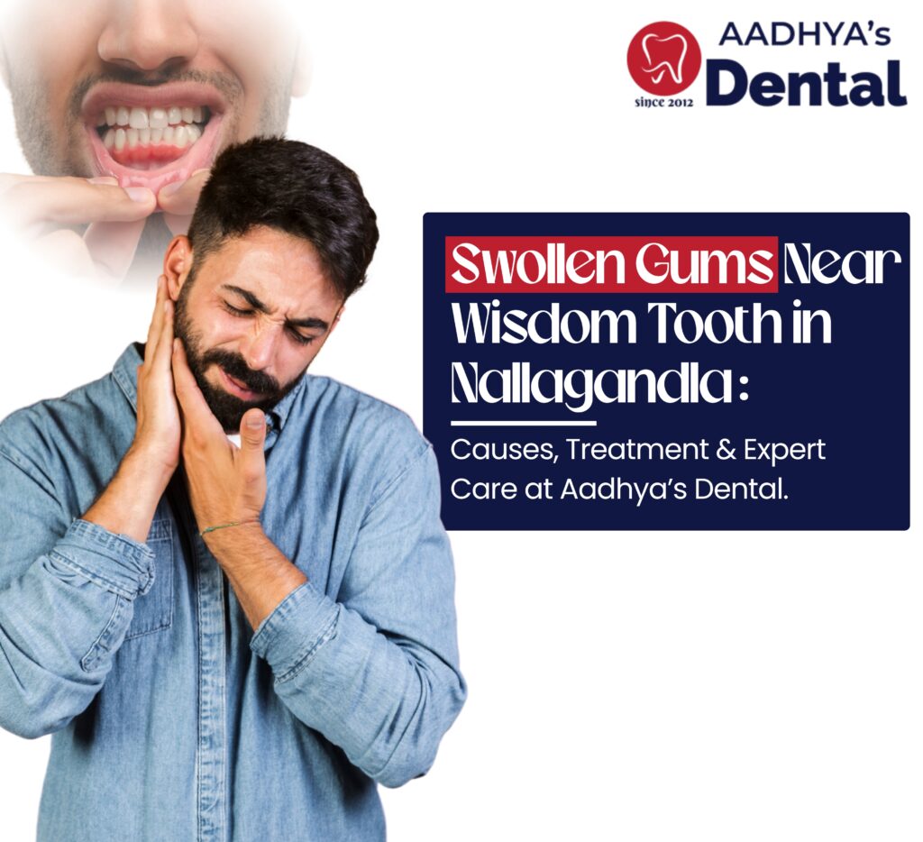 Swollen Gums Near Wisdom Tooth in Nallagandla