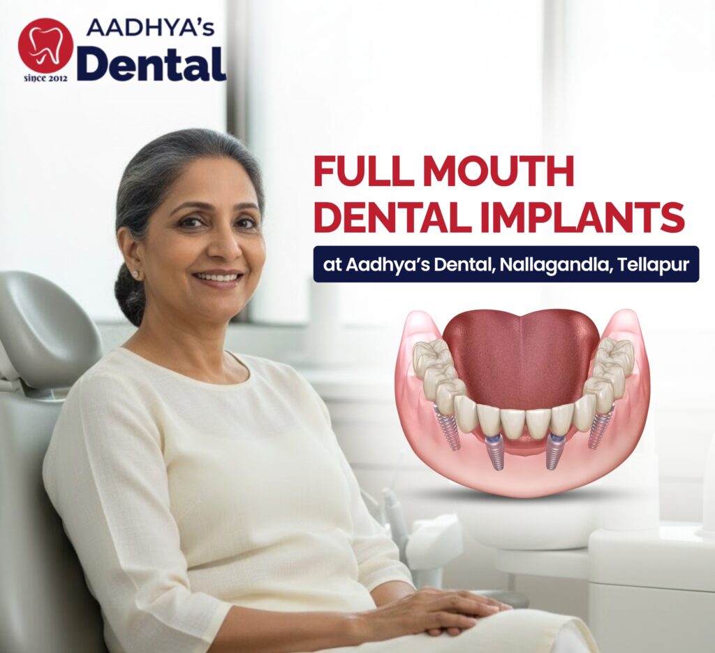 Full Mouth Dental Implants Nallagandla