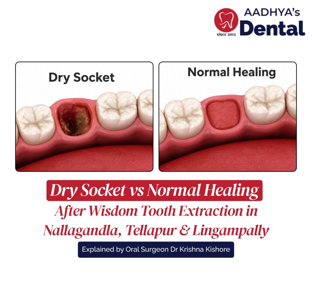 Wisdom Tooth Extraction in Nallagandla