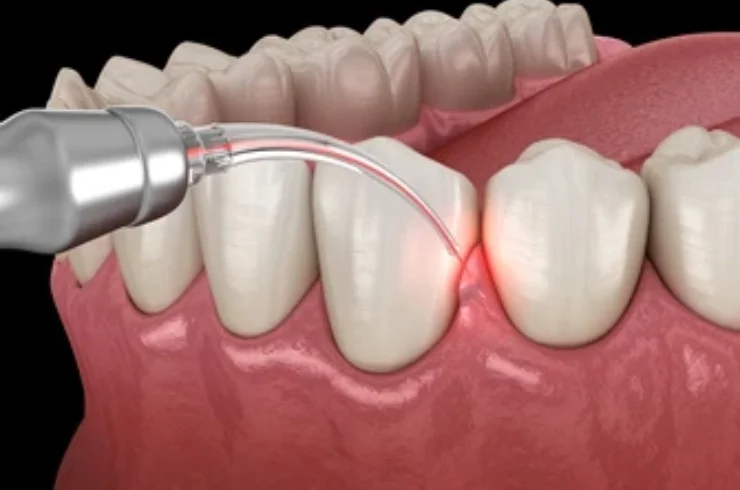 Laser Gum Surgeries