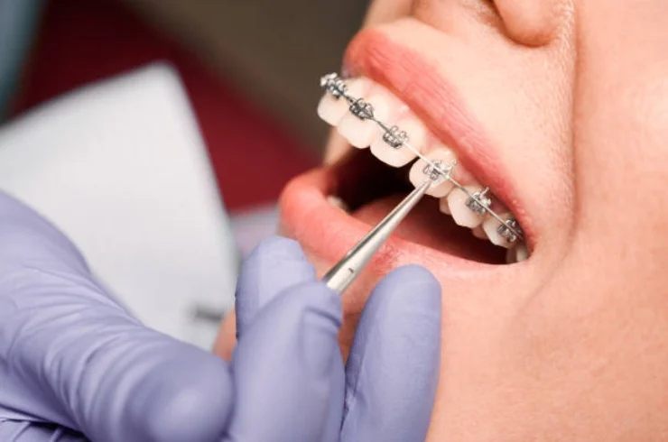 Orthodontic Aligners & Braces Treatments