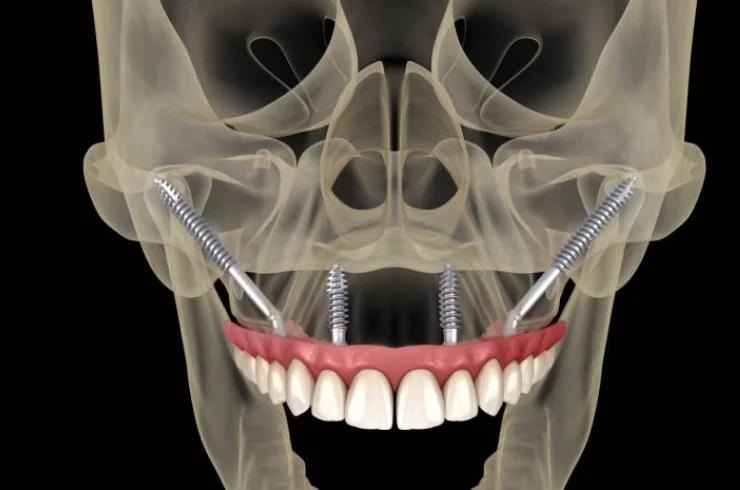 Quad Zygoma Rehabilitation