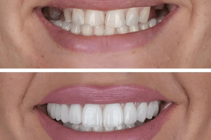 Single Day Smile Makeover