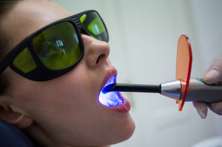 Tooth Colored Light Cure Fillings