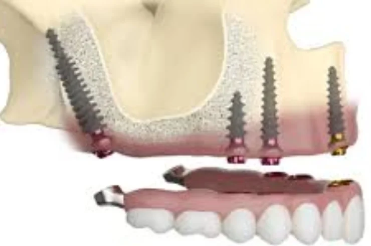 Zygoma Implants, Pterygoid Implants