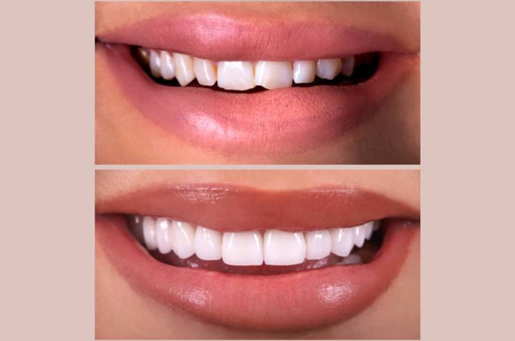 Teeth reshaping