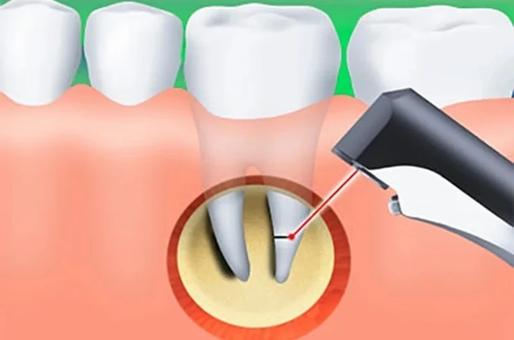 apicetomy root tip surgery